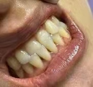 牙齿矫正牙贴面好吗，牙贴面手术前后对比