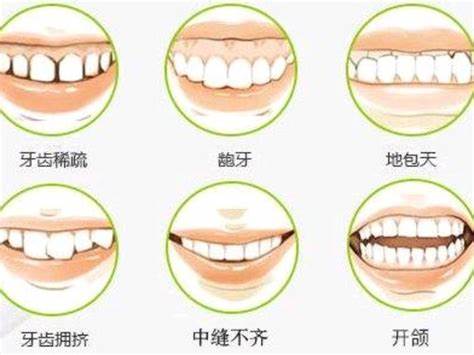 戴牙套一般花多少钱_费用影响__价格表