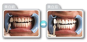 忻州牙齿美白2024价格表:德国费亚丹种植牙/颗:2400元起/以色列dentin(丹因)种植牙价格:2000元起