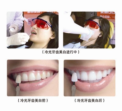 长春牙齿美白2024价格表:瑞典诺贝尔PMC种植牙:2300元起/ITI瑞锆种植牙/颗:3500元起