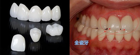 黑河全瓷牙种植2024价格表:瑞典诺贝尔种植牙/颗:3500元起/瑞士ITI种植牙/颗:4300元起