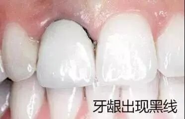 为什么医生不愿意拆烤瓷牙烤瓷牙有哪些情况需要赶紧拆除。