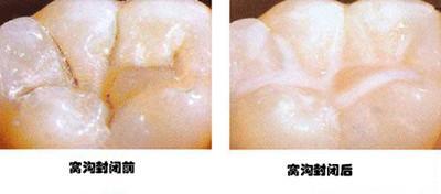 热议话题-儿童预成冠有必要做吗？探其使用寿命与优势解析