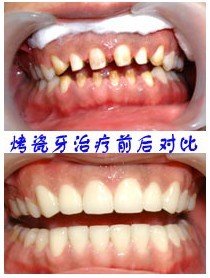 怎么判断是不是深覆合？请查收判断深覆合的方法及治疗方式~