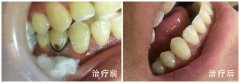 南海粤冠口腔收费价目表