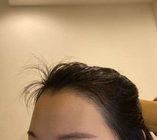广州前额植发需要多少钱，哪些口腔医院可以种植发际线