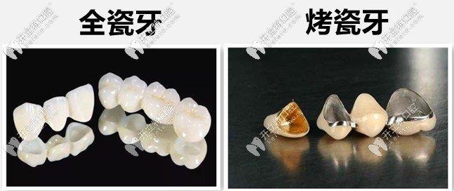 年轻人做烤瓷还是全瓷牙好？25岁血泪教训、牙龈黑线+核磁禁忌