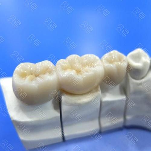 门牙全瓷牙能用多久？南宁天使口腔医生详解使用寿命与保养要点