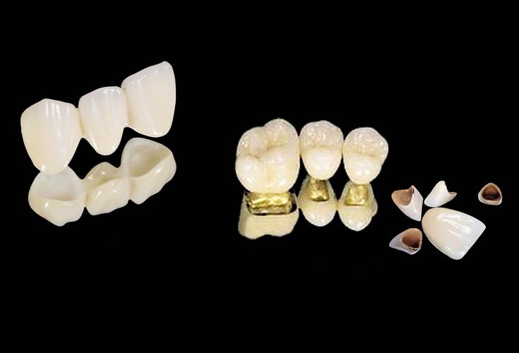 爱尔创瓷倍健全瓷牙的质量究竟如何，价格1600元贵吗？