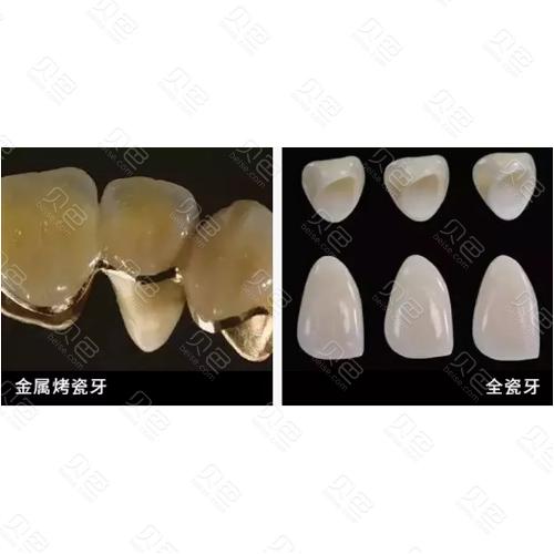 上海文博口腔医院烤瓷牙