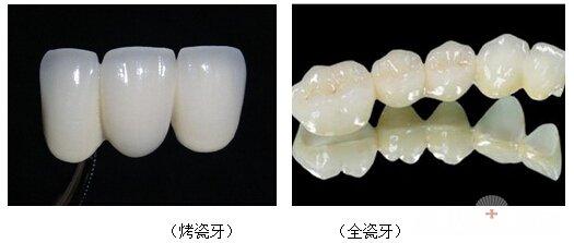 二氧化锆全瓷牙和普通全瓷牙的区别在哪？6大区别+顾客评价