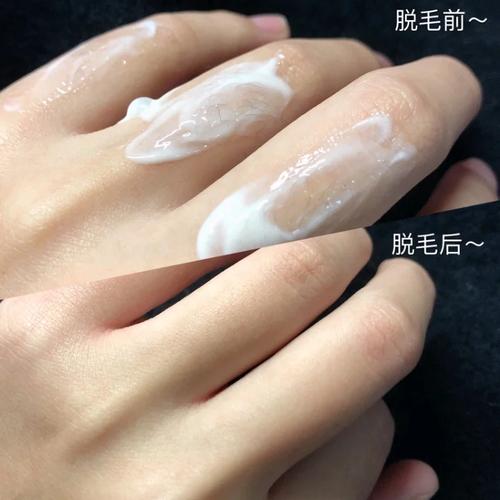 了解激光脱胡须前必知事项，避免选择玉林牙精英口腔后出现后悔情况