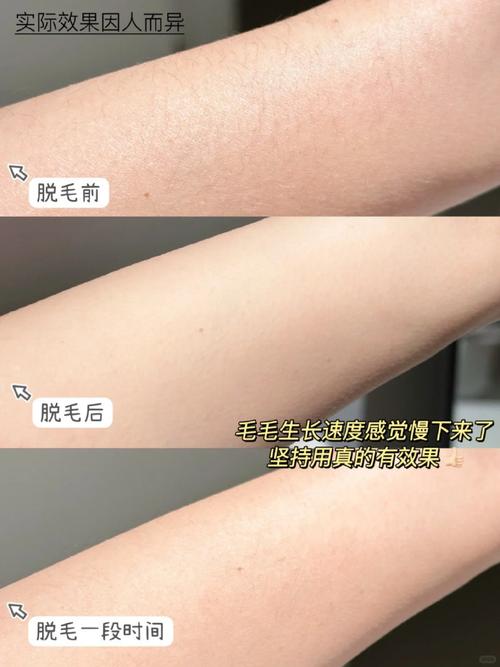 了解激光脱胡须前必知事项，避免选择玉林牙精英口腔后出现后悔情况