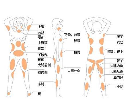 上海薇琳医疗美容医院技术怎么样？吸脂手术效果好吗？真人案例解析