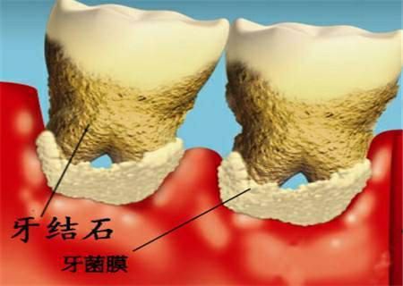 绵阳地区提供烤瓷牙服务