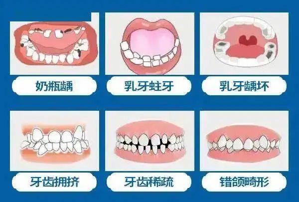 孩子戴herbst矫正器怎么样？有效改善下巴后缩、真实病例分析