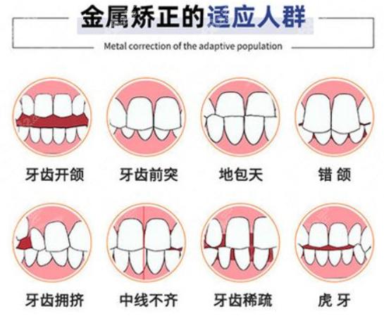国产矫正价格低意味着品质差吗？欧亚协合医院正雅隐形矫正值得信任