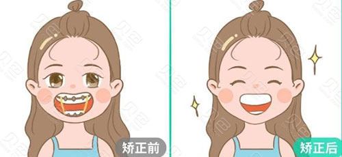 牙齿矫正的真实经历：在