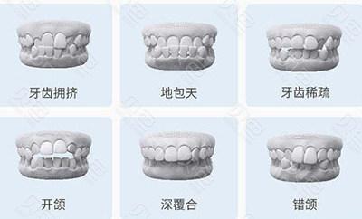 牙齿矫正选金属托槽矫正还是隐形矫正？区别有什么？