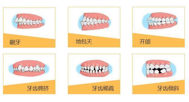 妃她正畸儿童矫正器价格表(OER儿童矫正5800起)6种型号、矫正好