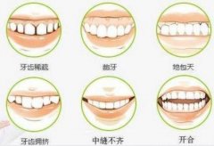 黄石牙齿矫正价格大曝光