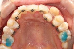 邵东晶典口腔牙齿矫正价