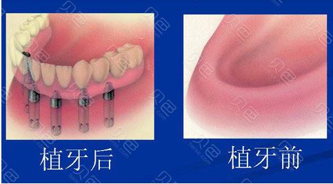 重庆河马口腔瑞士ITI种植牙5989元起，稳固逼真使用寿命长