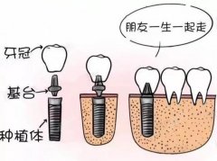 郑州宜佳口腔种植牙价格