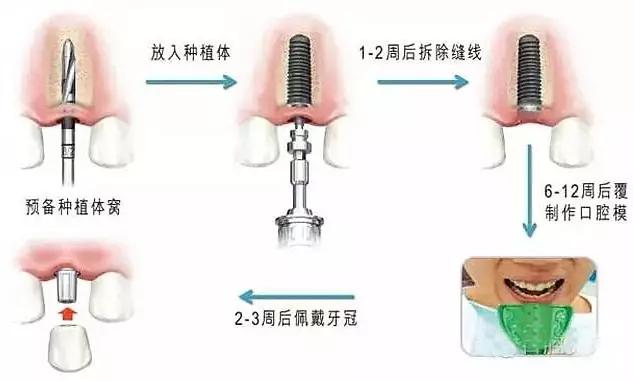 日本为什么不建议做种植