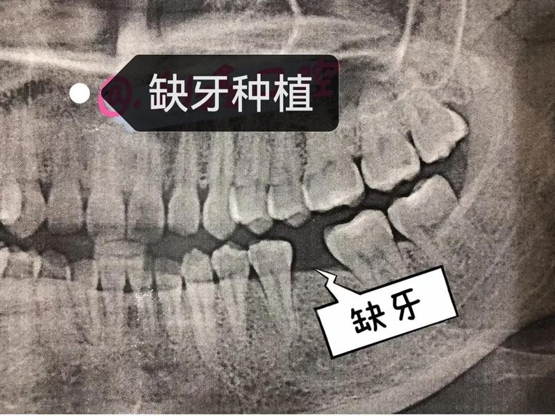 永康浙爱口腔种植中心地址+电话号码曝光：种植牙低至1880起