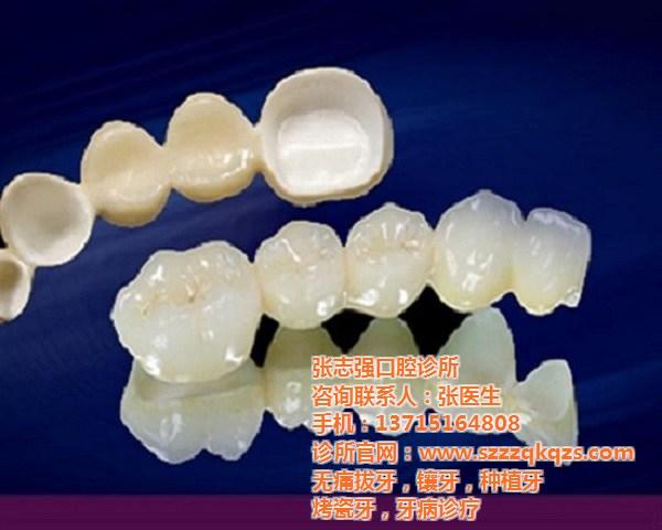 ​韩国奥齿泰适合做大牙吗？后牙专用SLA表面技术，骨结合快30%