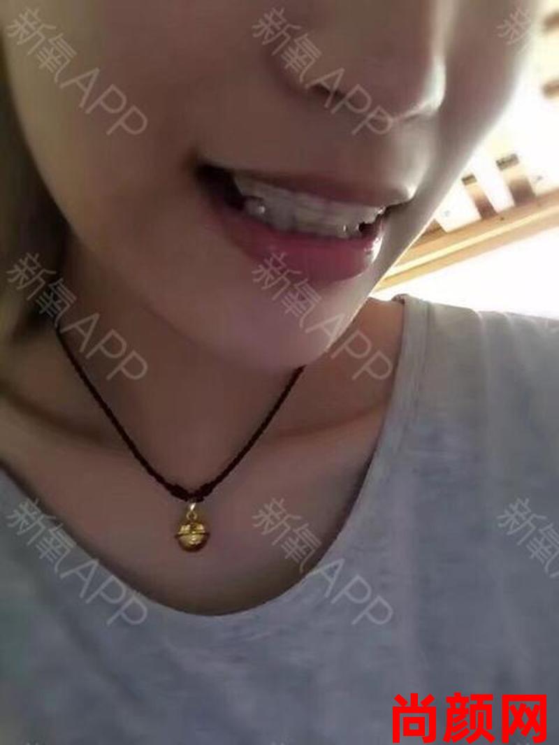 17岁牙套要带多久_17岁牙套要带多久呢