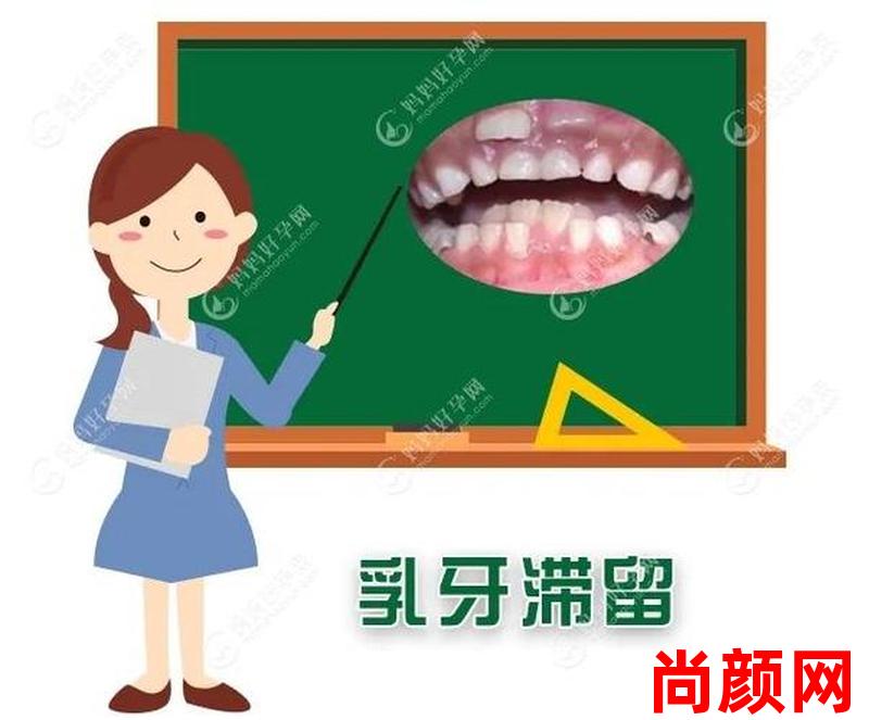 乳牙滞留多久-乳牙滞留多久一定要拔呢？如何预防