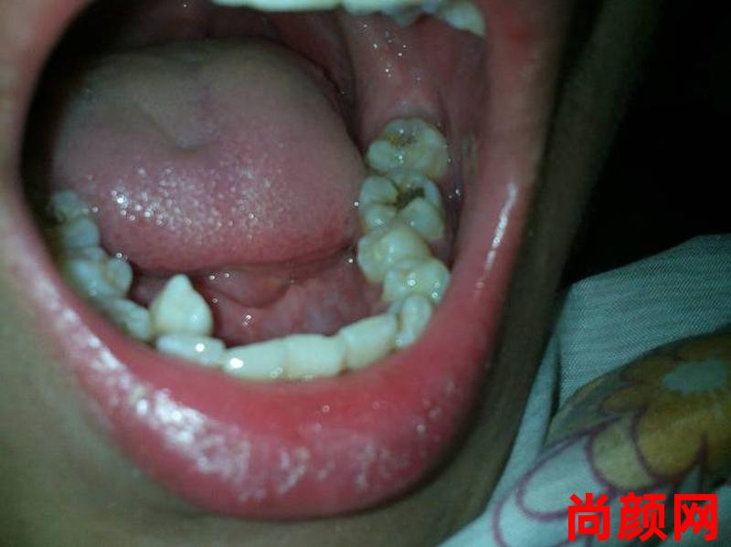 拔一个牙要多久能好—拔一个牙要多久能好呢