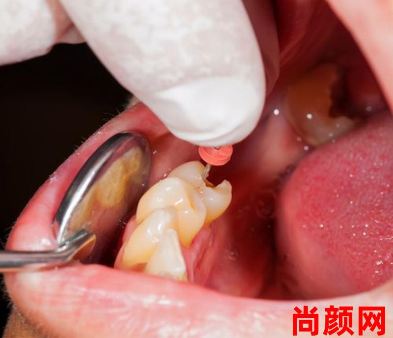 拔大牙会痛多久_拔大牙会痛多久才不痛