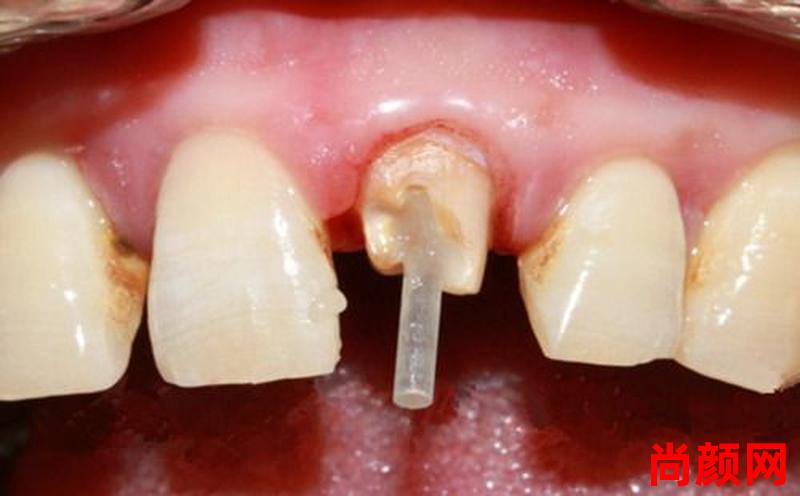拔完门牙多久可以补牙—拔完门牙多久可以补牙洞