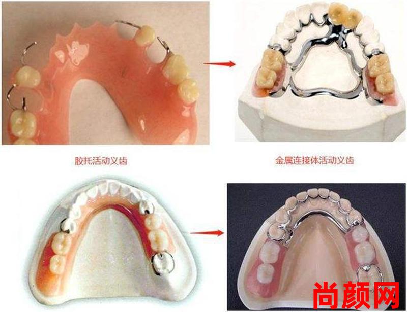 拔牙后多久可以镶牙-拔牙后多久可以镶牙多少钱