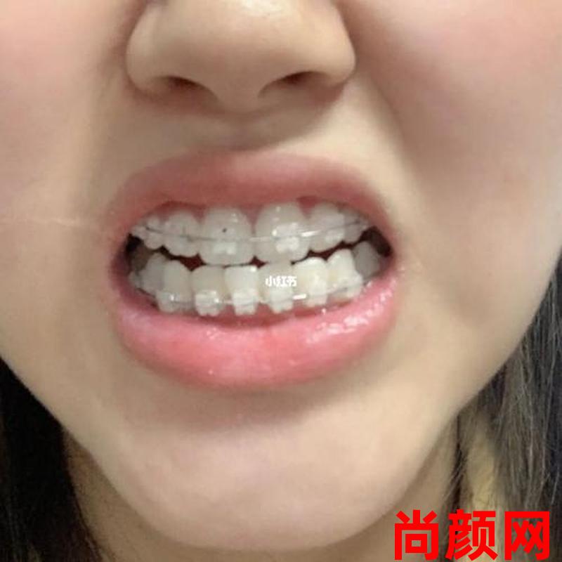 牙齿矫正戴牙套要多久,牙齿矫正戴牙套要多久才能完成