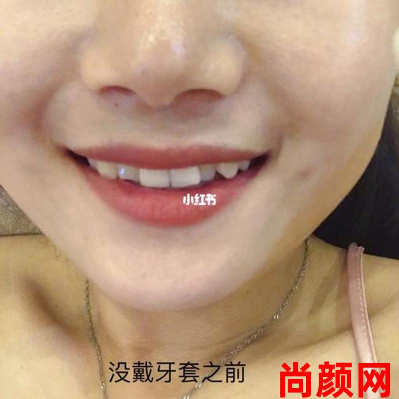 牙齿矫正的多久(牙齿矫正的多久做一次)