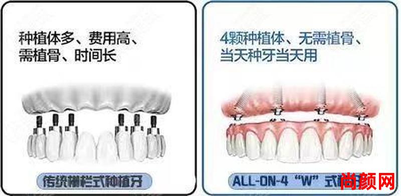 一段式种植牙使用时间—一段式种植牙使用时间多长