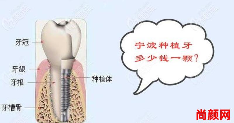上海成人种植牙一般多少钱(上海成人种植牙一般多少钱啊)