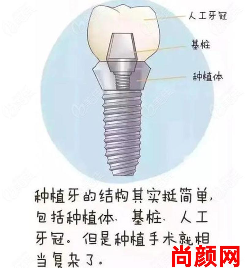 上牙2 3种植需要植骨吗,上牙2 3种植需要植骨吗视频 上牙2 3种植需要植骨吗,上牙2 3种植需要植骨吗视频