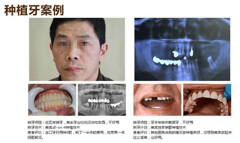 三叉神经痛能否做种植牙_三叉神经痛能否做种植牙齿
