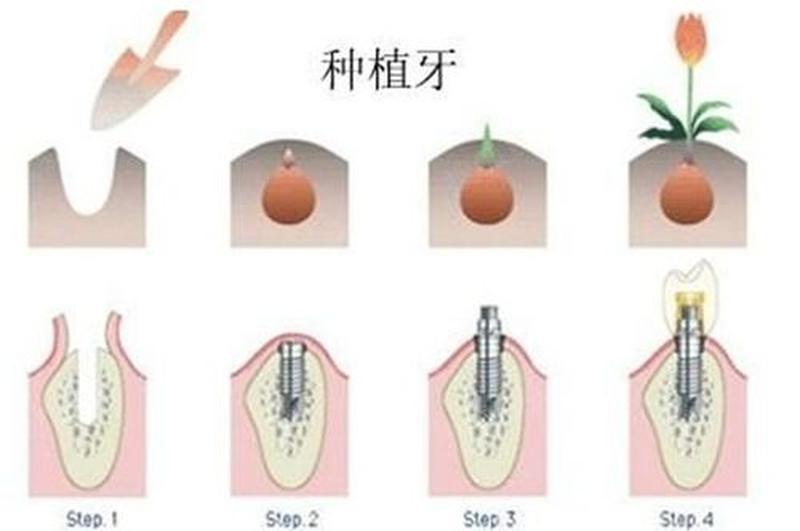 十年后种植牙会加快速度吗、十年后种植牙会加快速度吗图片
