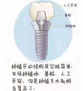 广州种植一颗牙多少钱一