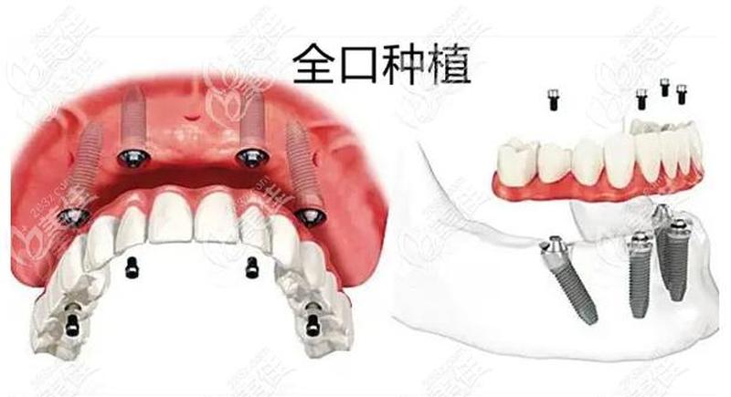 深圳全口牙种植多少钱一颗,深圳全口牙种植多少钱一颗啊