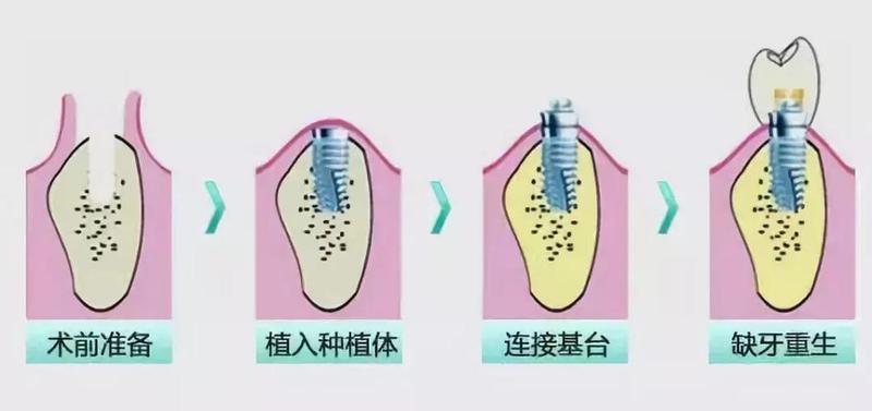 牙种植一期二期三期分别是什么-种植牙齿一期二期三期是什么意思啊
