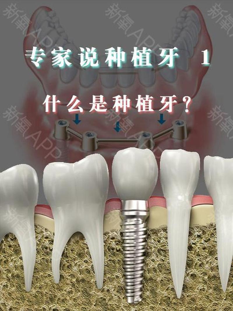 牙种植体已经植入了怎么办,牙种植体已经植入了怎么办还疼 牙种植体已经植入了怎么办,牙种植体已经植入了怎么办还疼