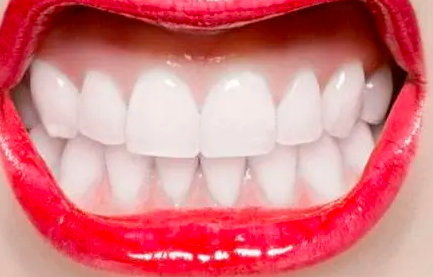 广州柏德口腔医院潘巨利牙齿种植真实效果