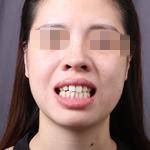 重庆新桥医院口腔科方晓琴牙齿矫正案例分享